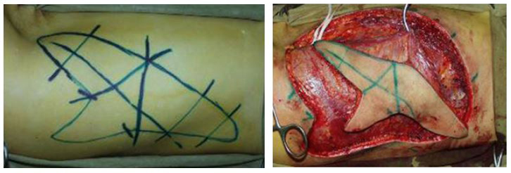Free autologous tissue transplantation after complicated contouring of the lower limbs 3