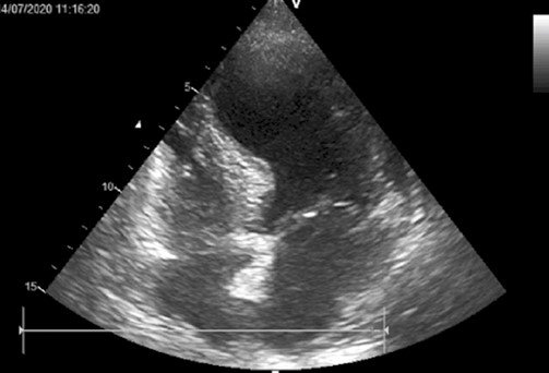 Takotsubo cardiomyopathy in an elderly woman 2