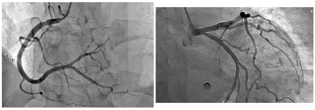 Takotsubo cardiomyopathy in an elderly woman 3