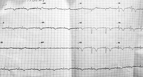 Takotsubo cardiomyopathy in an elderly woman 4