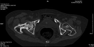 AJHMS N2 Mukuchyan Pagets disease 2