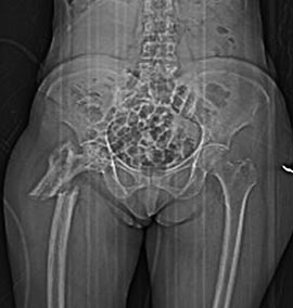 AJHMS N2 Mukuchyan Pagets disease 3